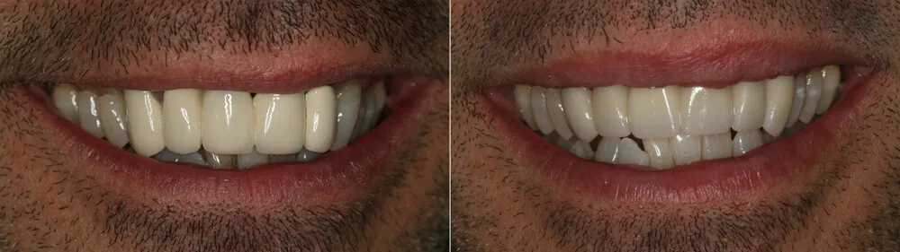 Before and after picture of patient whose smile was improved by using dental crowns in Las Vegas.